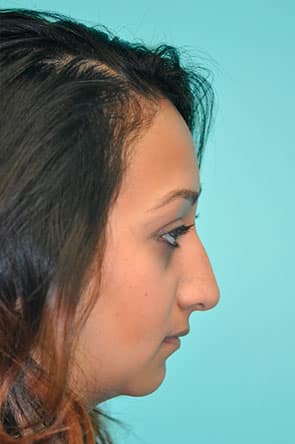 Herndon and Chevy Chase nasal anatomy
