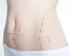 A good candidate for body sculpting has significant weight loss either through diet, exercise or bariatric surgery.