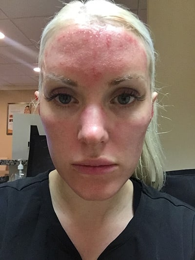 Microneedling patient Virginia before 1