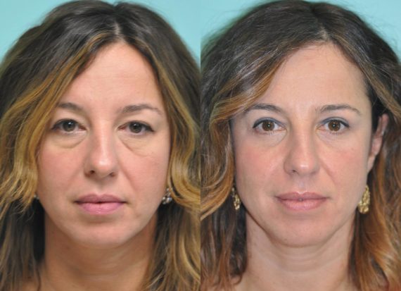 Before and after Blepharoplasty by Dr. Shervin Naderi, Patient 10265