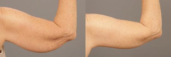 Before and after Brachioplasty (Arm Lift) by Dr. Shervin Naderi, Patient 9365