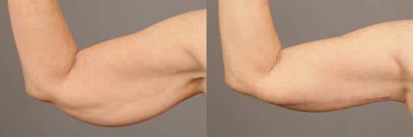 Before and after Brachioplasty (Arm Lift) by Dr. Shervin Naderi, Patient 9365