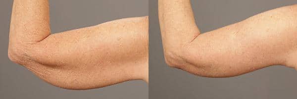 Before and after Brachioplasty (Arm Lift) by Dr. Shervin Naderi, Patient 9365