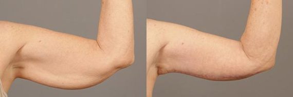 Before and after Brachioplasty (Arm Lift) by Dr. Shervin Naderi, Patient 9365