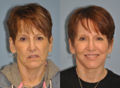 Before and after Facelift by Dr. Shervin Naderi, Patient 10269