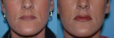 Before and after Lip Augmentation by Dr. Shervin Naderi, Patient 8934