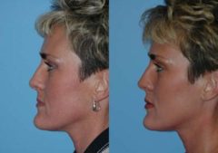 Before and after Lip Augmentation by Dr. Shervin Naderi, Patient 8934