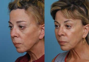 Before and after Mid-Facelift by Dr. Shervin Naderi, Patient 8909