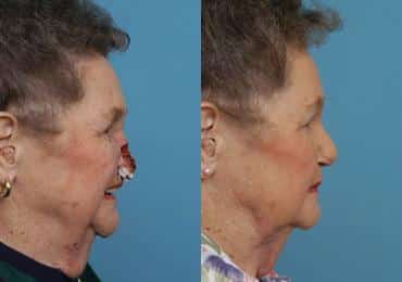 Before and after Mohs Reconstruction by Dr. Shervin Naderi, Patient 8942