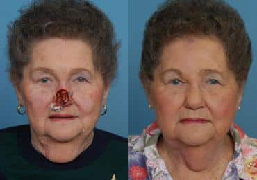 Before and after Mohs Reconstruction by Dr. Shervin Naderi, Patient 8942