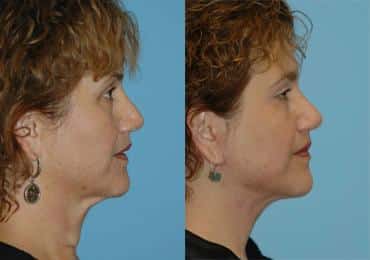 Before and after Neck Lift by Dr. Shervin Naderi, Patient 8957