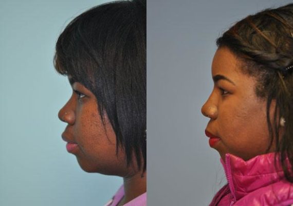 Before and after Non-Surgical Rhinoplasty by Dr. Shervin Naderi, Patient 8911