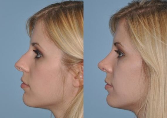 Before and after Revision Rhinoplasty by Dr. Shervin Naderi, Patient 8895