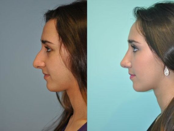 Before and after Rhinoplasty by Dr. Shervin Naderi, Patient 8839