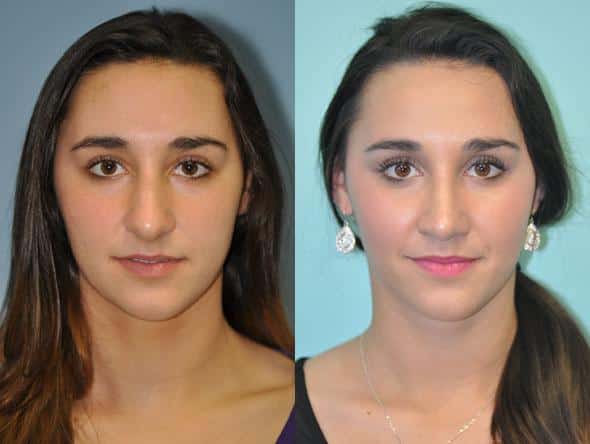 Before and after Rhinoplasty by Dr. Shervin Naderi, Patient 8839