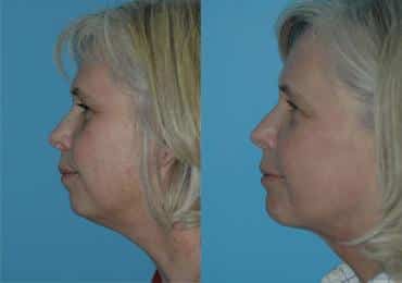 Before and after Skin Resurfacing by Dr. Shervin Naderi, Patient 8940