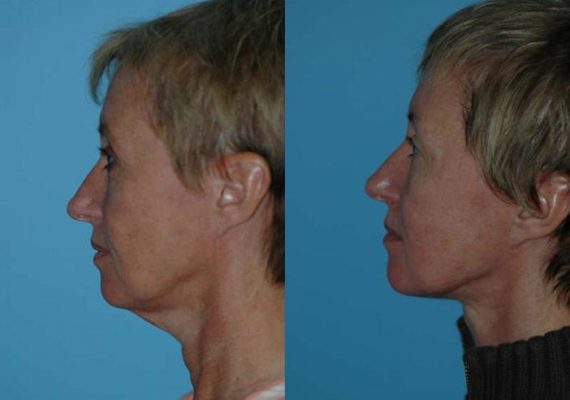 Before and after Submentoplasty by Dr. Shervin Naderi, Patient 8938