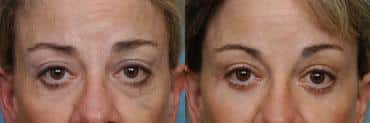 Before and after Blepharoplasty by Dr. Shervin Naderi, Patient 8926