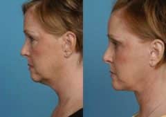 Facelift before and after at The Naderi Center, Reston, VA and Chevy Chase, MD, Patient 8907