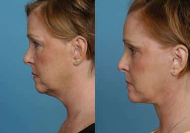 Before and after Facelift by Dr. Shervin Naderi, Patient 8907