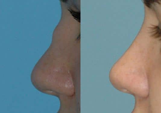 Before and after Revision Rhinoplasty by Dr. Shervin Naderi, Patient 8898