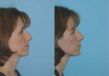 Before and after Rhinoplasty by Dr. Shervin Naderi, Patient 8845