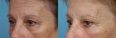 Before and after Blepharoplasty by Dr. Shervin Naderi, Patient 8927