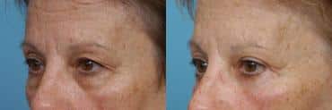 Before and after Blepharoplasty by Dr. Shervin Naderi, Patient 8927