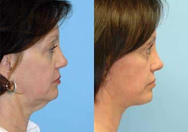 Before and after Facelift by Dr. Shervin Naderi, Patient 8908