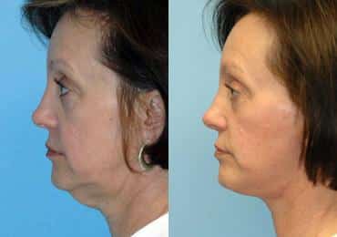 Before and after Facelift by Dr. Shervin Naderi, Patient 8908