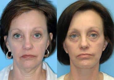 Before and after Facelift by Dr. Shervin Naderi, Patient 8908