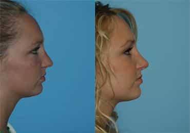 Before and after Rhinoplasty by Dr. Shervin Naderi, Patient 8846