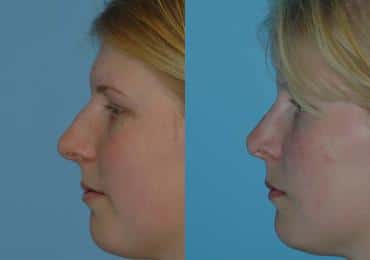 Before and after Rhinoplasty by Dr. Shervin Naderi, Patient 8847