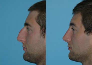 Before and after Rhinoplasty by Dr. Shervin Naderi, Patient 8848