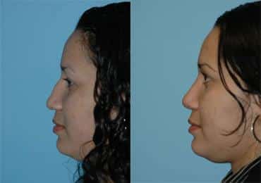 Before and after Rhinoplasty by Dr. Shervin Naderi, Patient 8849