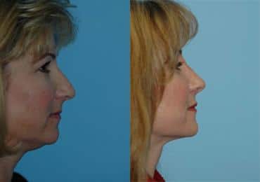 Before and after Rhinoplasty by Dr. Shervin Naderi, Patient 8850