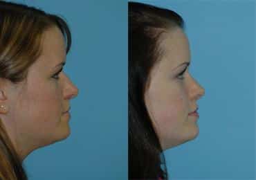 Before and after Rhinoplasty by Dr. Shervin Naderi, Patient 8851