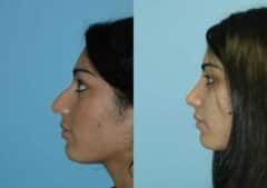 Before and after Rhinoplasty by Dr. Shervin Naderi, Patient 8852