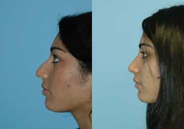 Before and after Rhinoplasty by Dr. Shervin Naderi, Patient 8852