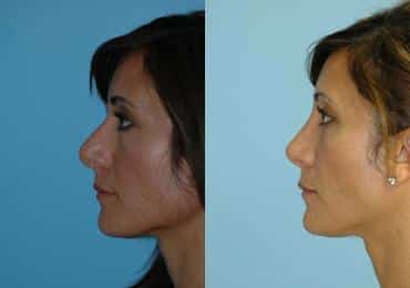 Before and after Rhinoplasty by Dr. Shervin Naderi, Patient 8853