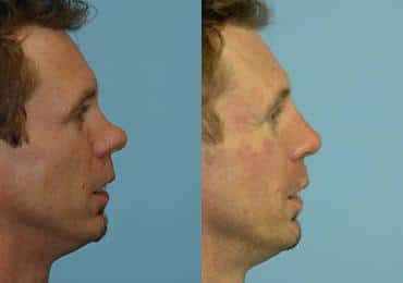 Before and after Rhinoplasty by Dr. Shervin Naderi, Patient 8854