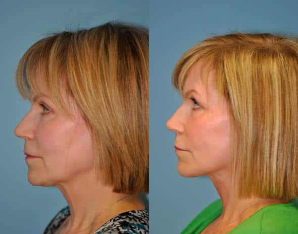 Before and after Facelift by Dr. Shervin Naderi, Patient 8899