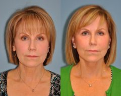 Before and after Facelift by Dr. Shervin Naderi, Patient 8899