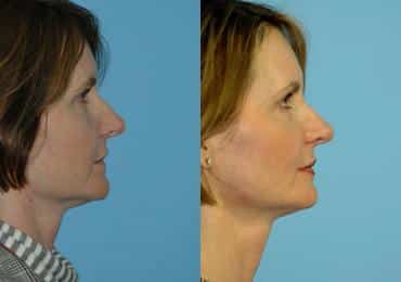 Before and after Lip Implant by Dr. Shervin Naderi, Patient 8935