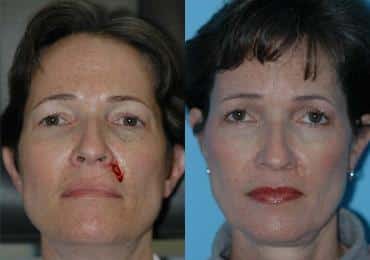 Mohs Reconstruction photos | Chevy Chase, MD | Patient 8943