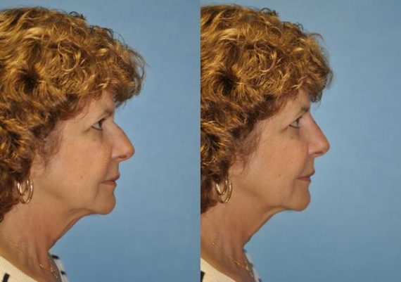 Non-Surgical Rhinoplasty before and after photos in Chevy Chase, MDNon-Surgical Rhinoplasty Before and After Photos in Chevy Chase, MD