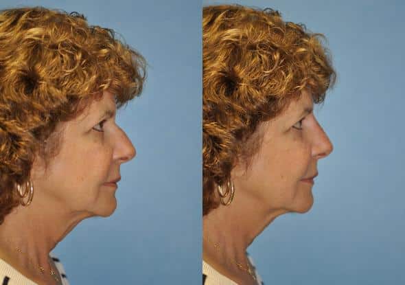 Before and after Non-Surgical Rhinoplasty by Dr. Shervin Naderi, Patient 8912