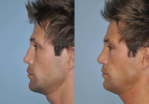 Before and after Revision Rhinoplasty by Dr. Shervin Naderi, Patient 8897