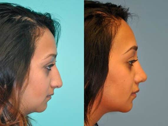 Before and after Rhinoplasty by Dr. Shervin Naderi, Patient 8838