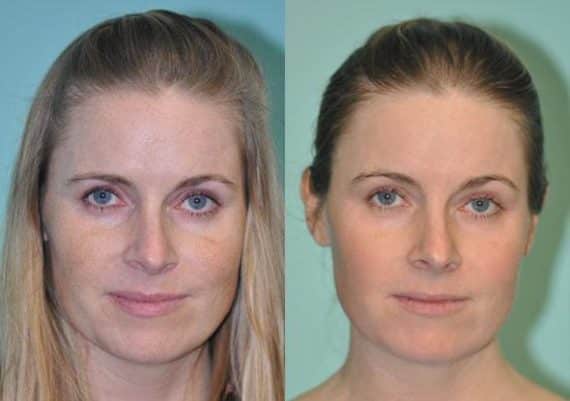 Before and after Skin Resurfacing by Dr. Shervin Naderi, Patient 8941